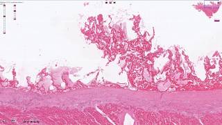 Fibrinous Pericarditis  Histopathology [upl. by Adnilem]