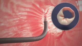 Endoscopic Sleeve Gastroplasty ESG Procedure Animation [upl. by Daniella988]