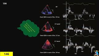 Cardiac Dyssynchrony [upl. by Leticia885]