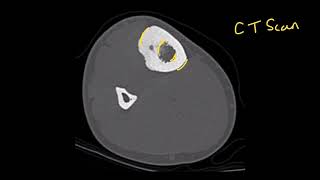 Radiological features of osteoid osteoma [upl. by Darryn]