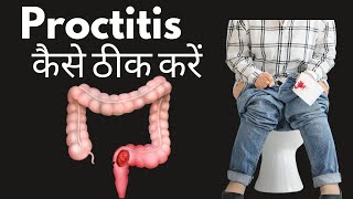 Proctitis symptoms and treatment in Hindi  proctitis kya hai  proctitis ka ilaaj [upl. by Recnal38]