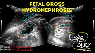 Fetal Unilateral Hydronephrosis  Ultrasound  Anomaly  Case 44 [upl. by Charlena]