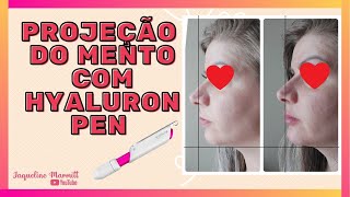 Preenchimento de Mento com Hyaluron Pen AH Reticulado Princess Volume [upl. by Blodgett]