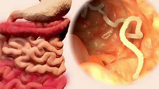 How to Get Rid of Intestinal Parasites recipe  Home Remedies [upl. by Alabaster425]