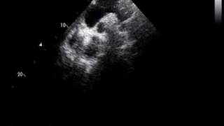 coarctation of the aorta and RHDmild mitral stenosis [upl. by Lula]