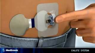 EN Inserting the Enlite Sensor with Paradigm® Veo™ insulin pump Paradigm® Revel [upl. by Okiman]