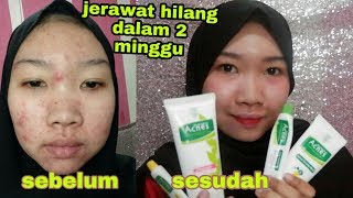 REVIEW JUJUR ACNES TREATMENT SERIES SKINCARE UNTUK MUKA BERJERAWAT acnes [upl. by Dal]