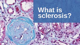 What is Sclerosis  Pathology mini tutorial [upl. by Andromede]