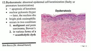 Histopathology 6 👉 Dyskeratosis [upl. by Riggins372]