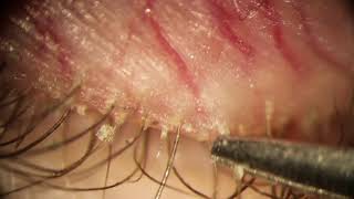 Parasite Removal from Eyelids  Clear Arachnids with Forceps [upl. by Milde]