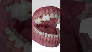 Digital Dental Implant Workflow dentist custom [upl. by Aigneis]