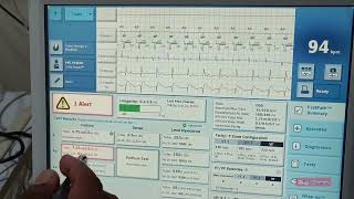 Cardiac Resynchronisation Therapy Defibrillator  CRTD   Heart Device [upl. by Akeimahs]