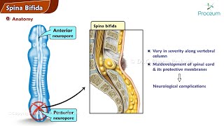 Spina Bifida  Orthopedics Lecture [upl. by Barbour175]