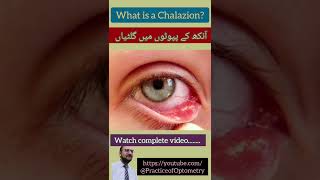 Chalazion  Meibomian Cyst  Eyelid Cyst  Practice Of Optometry  Eye Exam  Eye Lump  Eye Pain [upl. by Ydennek555]