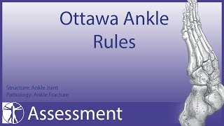 Ottawa Ankle Rules  Ankle Fracture [upl. by Aurthur]