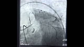 Left main Trifurcation stenting under Ivus guidance with RCA CTO and EF 35 [upl. by Lail]