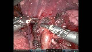 Robotic right lower lobectomy with gross N1 disease on the A5 PA [upl. by Jerroll]