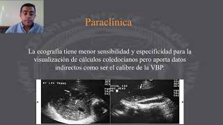 Colecistitis aguda Clínica diagnóstico exámenes complementarios y tratamiento [upl. by Assital]