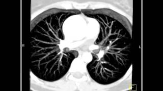 VascularAscending aorta3D and 4D mapping demonstrating a dilated ascending aorta8 of 10 [upl. by Scevor588]