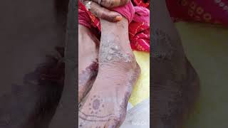 TINEA CORPORIS fungaldisease skincare ulcers viralvideo shorts medicine physician [upl. by Clie]