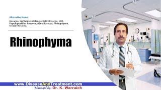 Rhinophyma  Causes Diagnosis Symptoms Treatment Prognosis [upl. by Asante430]