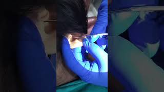 PATCHING PROCEDURE FOR EAR DRUM PERFORATION [upl. by Anigriv]