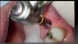 Implant flapless surgery [upl. by Sardse]