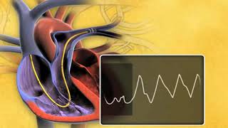 Swan Ganz Thermodilution Pulmonary Artery Catheter rdyUjTB4vaU mpeg4 [upl. by Clynes]