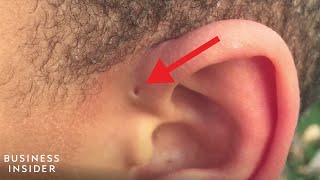 Explaining A Preauricular Sinus A Tiny Hole Above Some Peoples Ears [upl. by Ahsenit155]