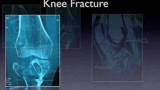 Treatment of a Knee Fracture Tibial Plateau in a Patient with an ACL Reconstruction [upl. by Evelina]