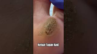 BUANG KETUAT VIRAL WARTS KAT TAPAK KAKI AKAR DALAM SAKIT  DrMan Ttdi Story [upl. by Notsla]