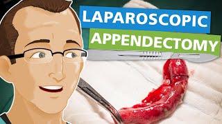 Laparoscopic Appendectomy [upl. by Aala]