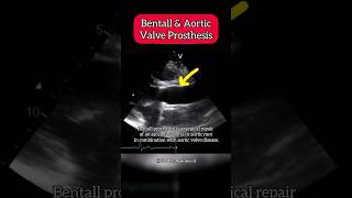 Bentall and aortic Valve Prosthesis on Echocardiography aortic Heart [upl. by Cece]