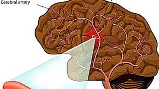 Intracerebral HemorrhageICHEtiology PathophysiologyClinical Features Diagnostic Treatment [upl. by Heger]