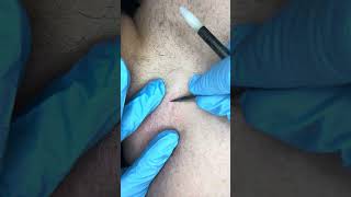 Watch electrolysis Back hairs permanent hair removal [upl. by Honoria]