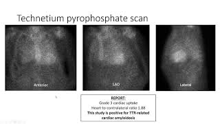 July 2020 Topics in Cardio Oncology Webinar [upl. by Othe960]