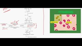 Glucose 6 phosphate dehydrogenase deficiency  Hemolytic anemia pathology [upl. by Sualohcin]