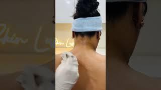 Chemical peel for body pigmentation pigmentationtrending skinpigmentation underarmpigmentation [upl. by Akcirred]