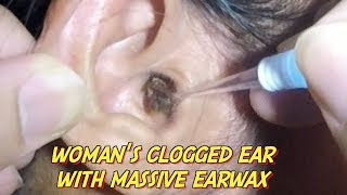 Womans Clogged Ear with Massive Earwax is Finally Removed [upl. by Rento983]