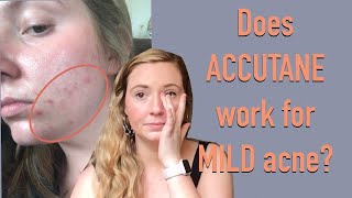 My Accutane Experience MILD persistent acne [upl. by Shaylynn]