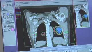 Cancer Treated with Radiation Therapy [upl. by Nomead]