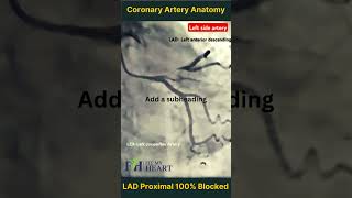 100 Blocked Proximal LAD Artery  Coronary Anatomy Overview FitMyHeart [upl. by Kariotta]