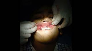 Eneucleation of periapical cyst [upl. by Acnalb]