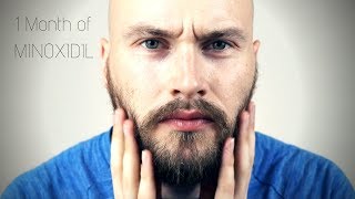 MINOXIDIL BEARD JOURNEY  1 Month Update [upl. by Oos]