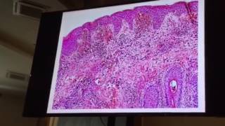 Micosis fungoides hipopigmentada más papulosis linfomatoide Bucaramanga 2016 [upl. by Ada]