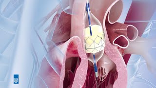 TAVI bei Aortenklappenstenose  Medizin Animation [upl. by Shipp]