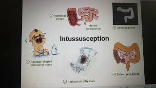 Intussusception part 1 [upl. by Halladba]