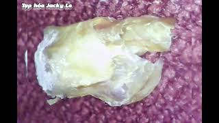 Ear Wax Removal 142 Dry thick itchy earwax  Ear Cleaning ASMR Relaxing Video [upl. by Enelhtac]