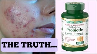 I STARTED TAKING PROBIOTICS FOR MY ACNE  GETTING RID OF ACNE IN ONE WEEK EXPERIMENT [upl. by Euqram]