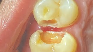 RESTORATION OF GROSSLY CAVITATED UPPER TEETH [upl. by Eneli]